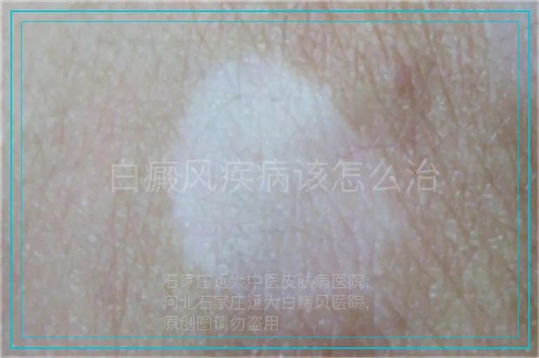 白癜风疾病该怎么治