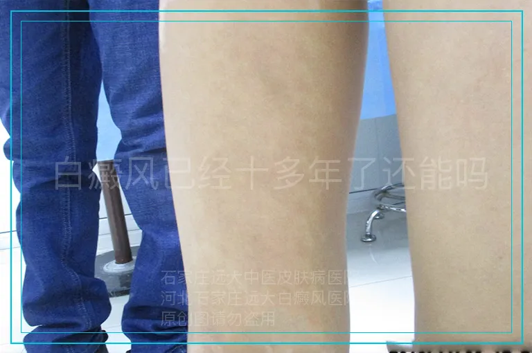 白癜风已经十多年了还能吗