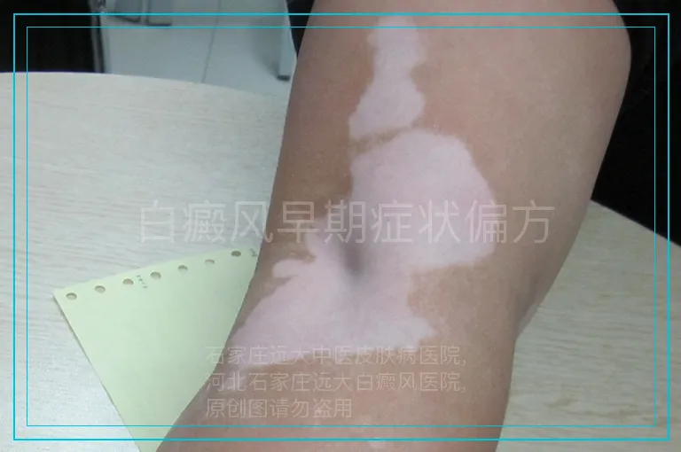白癜风早期症状偏方