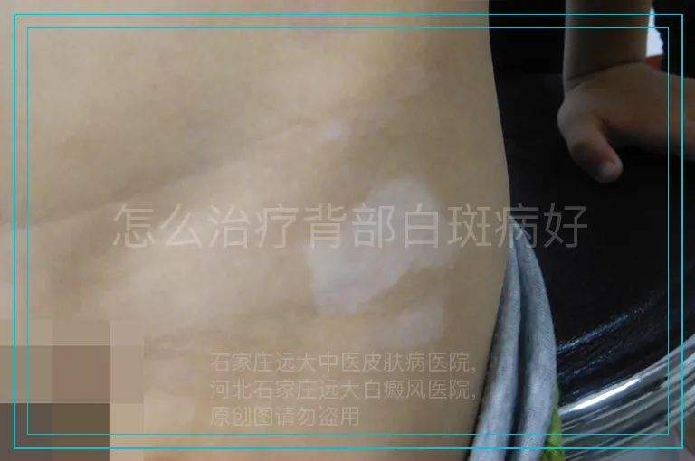 怎么治疗背部白斑病好
