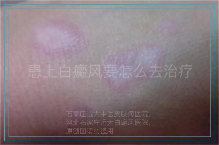 患上白癜风要怎么去治疗