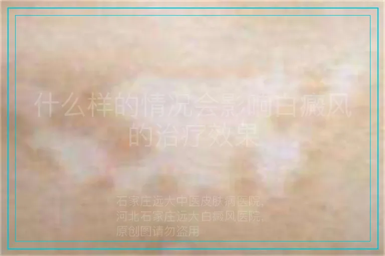 什么样的情况会影响白癜风的治疗效果