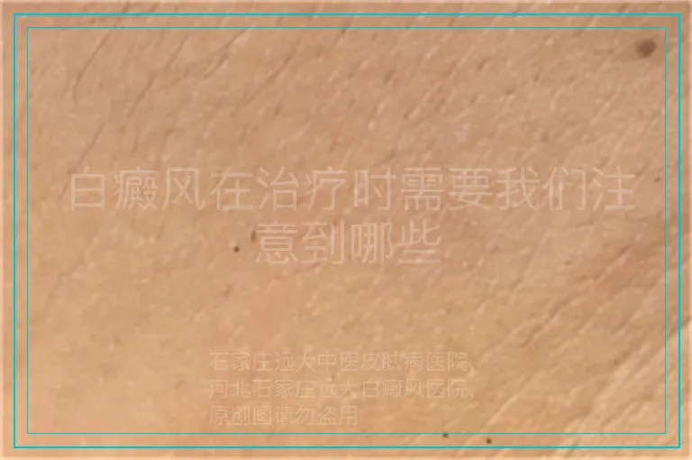 白癜风在治疗时需要我们注意到哪些