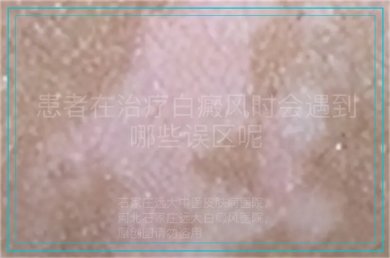 患者在治疗白癜风时会遇到哪些误区呢