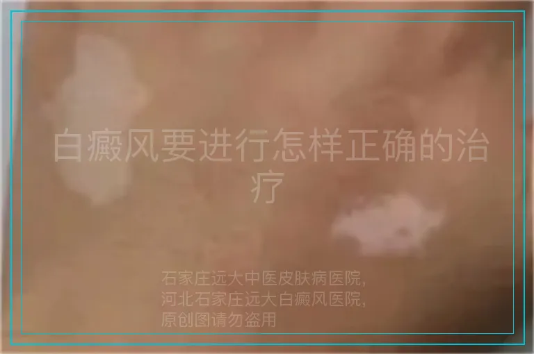 白癜风要进行怎样正确的治疗