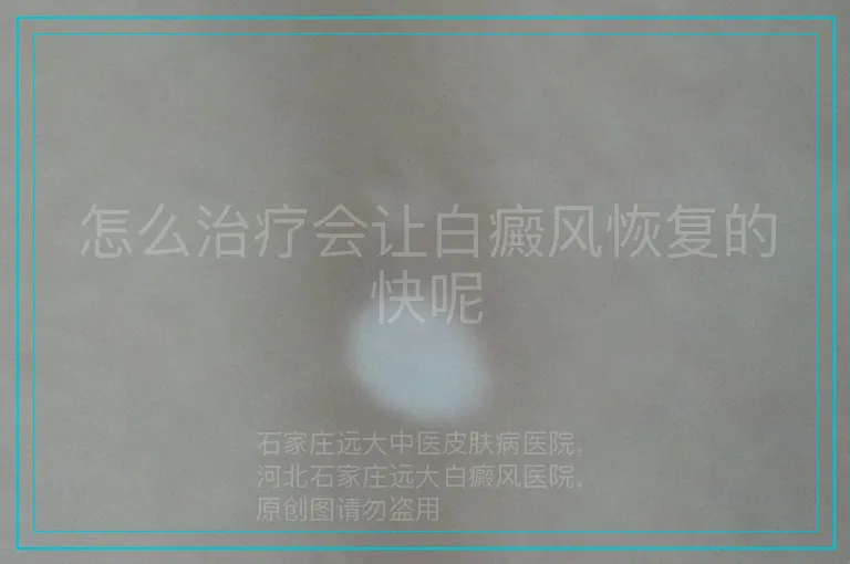 怎么治疗会让白癜风恢复的快呢