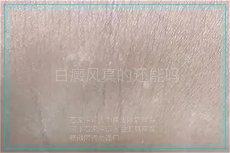 白癜风真的还能吗