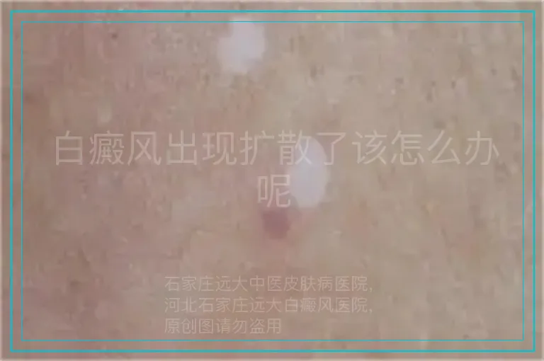 白癜风出现扩散了该怎么办呢