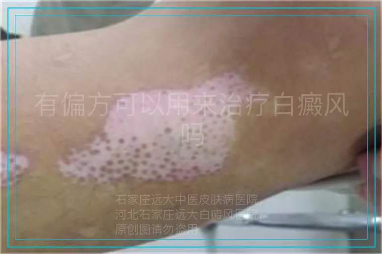 有偏方可以用来治疗白癜风吗