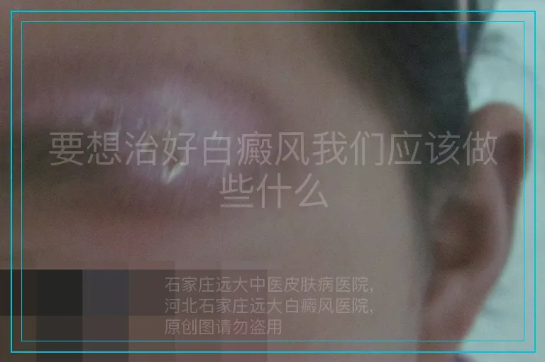 要想治好白癜风我们应该做些什么