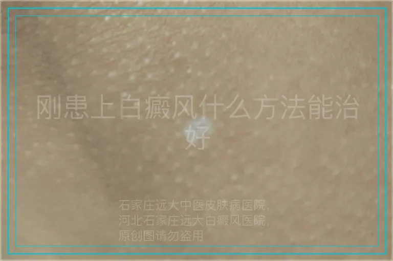 刚患上白癜风什么方法能治好