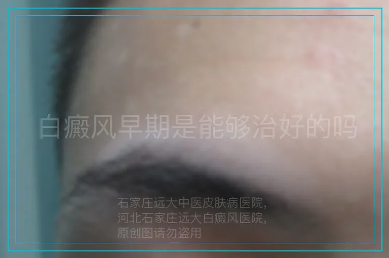 白癜风早期是能够治好的吗