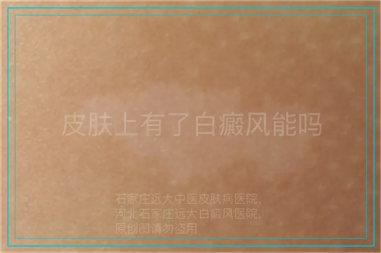 皮肤上有了白癜风能吗