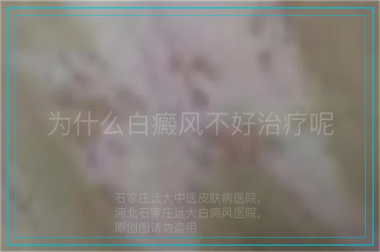 为什么白癜风不好治疗呢