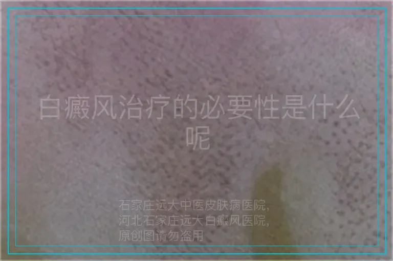 白癜风治疗的必要性是什么呢