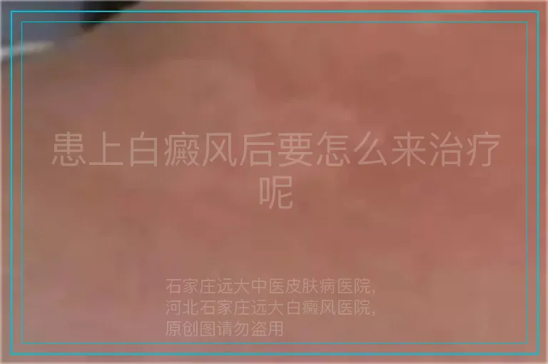 患上白癜风后要怎么来治疗呢