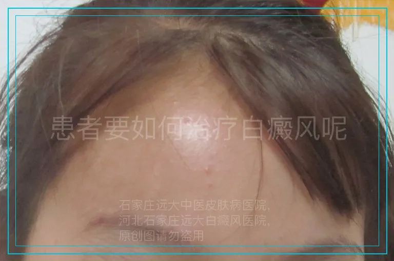 患者要如何治疗白癜风呢