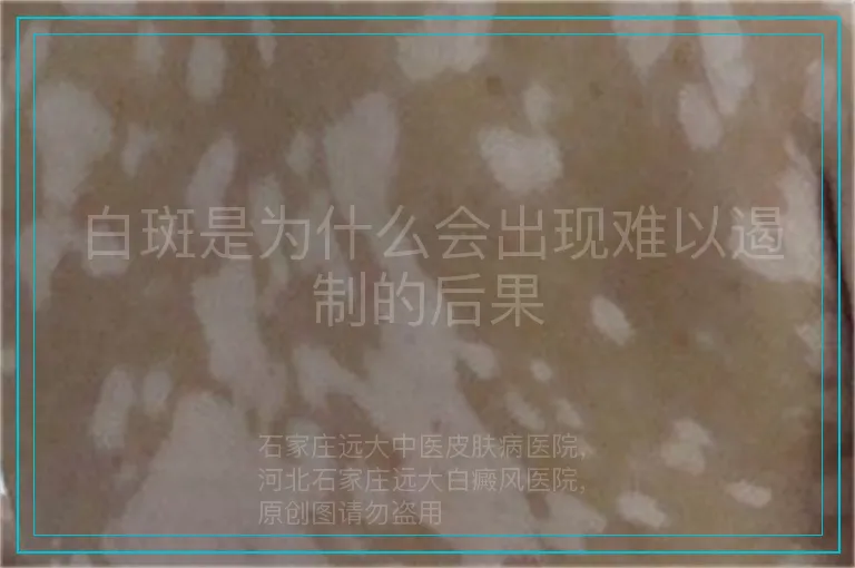 白斑是为什么会出现难以遏制的后果