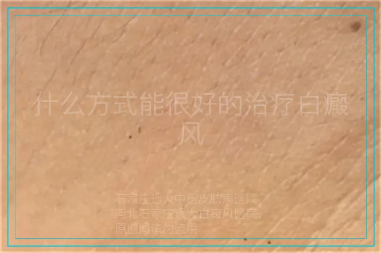 什么方式能很好的治疗白癜风