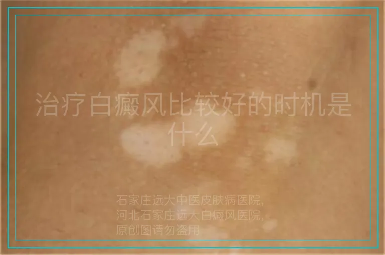 治疗白癜风比较好的时机是什么
