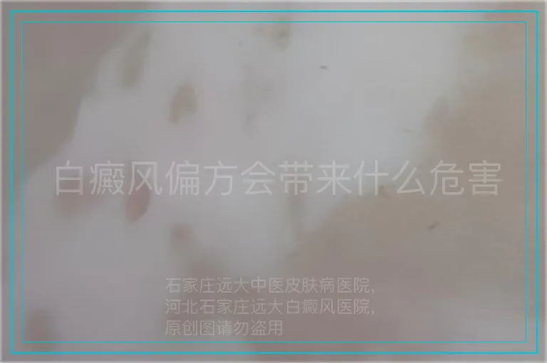 白癜风偏方会带来什么危害