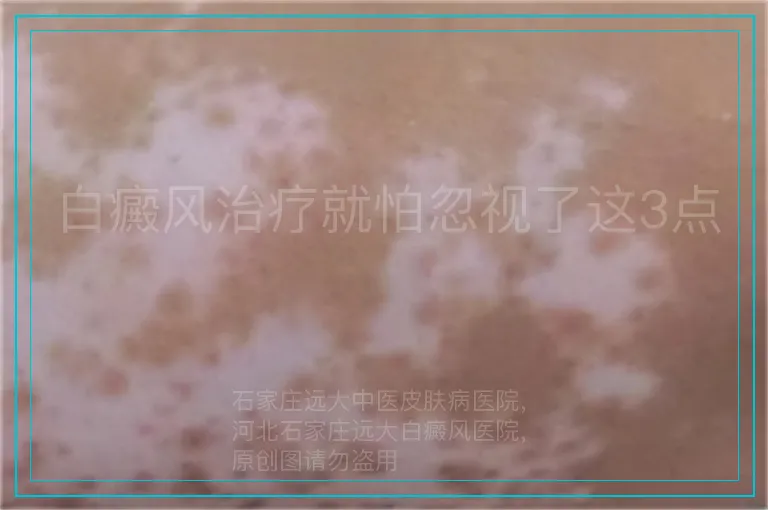 白癜风治疗就怕忽视了这3点