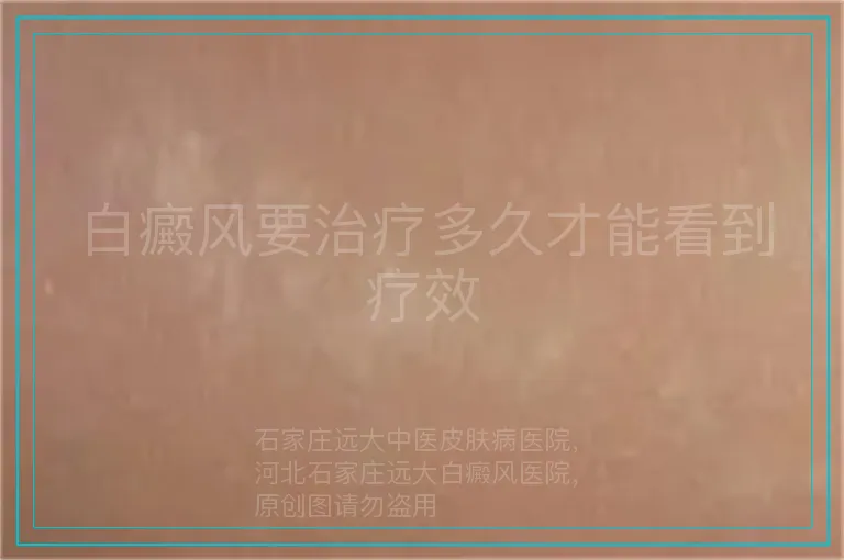 白癜风要治疗多久才能看到疗效