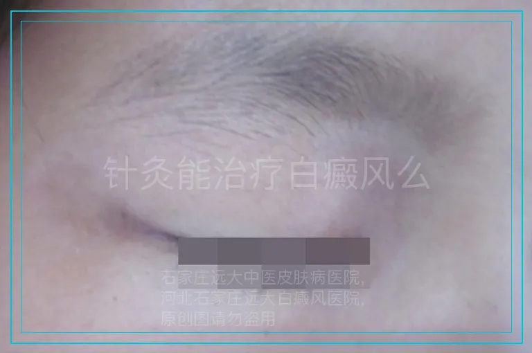 针灸能治疗白癜风么