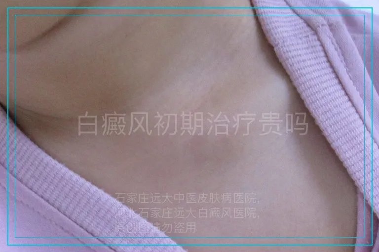 白癜风初期治疗贵吗