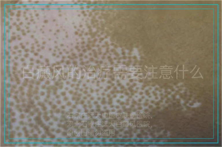 白癜风的治疗需要注意什么
