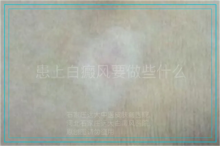 患上白癜风要做些什么