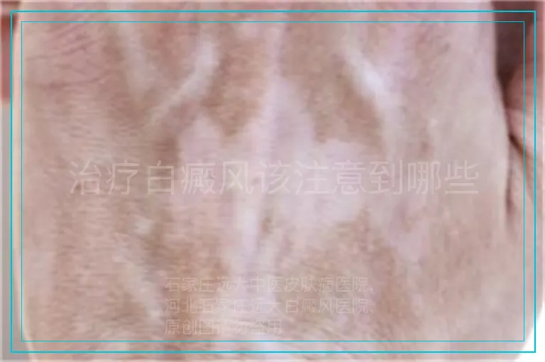 治疗白癜风该注意到哪些
