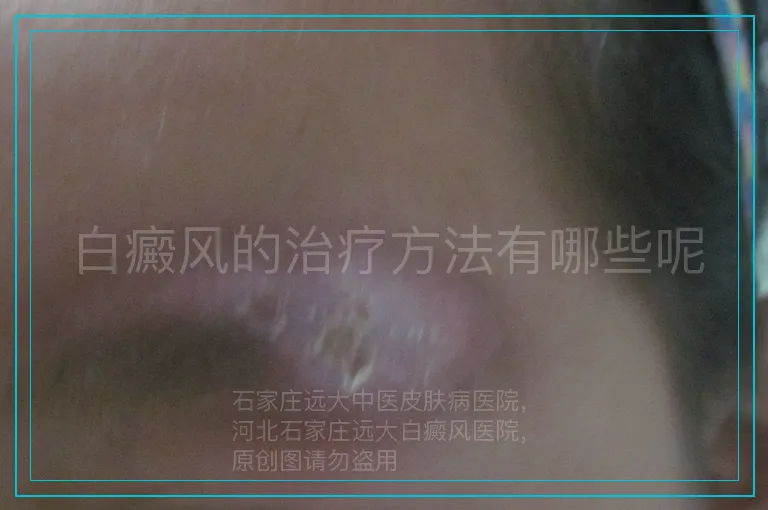 白癜风的治疗方法有哪些呢