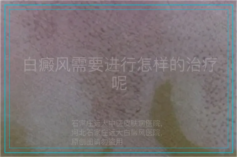 白癜风需要进行怎样的治疗呢