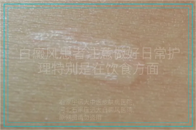 白癜风患者注意做好日常护理特别是在饮食方面
