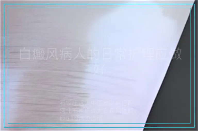 白癜风病人的日常护理应做好