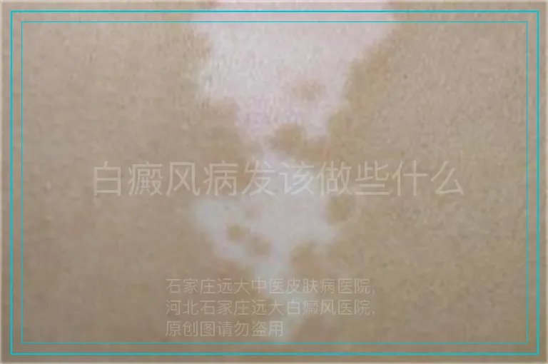 白癜风病发该做些什么