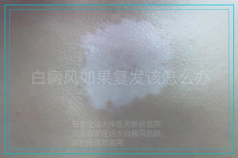白癜风如果复发该怎么办