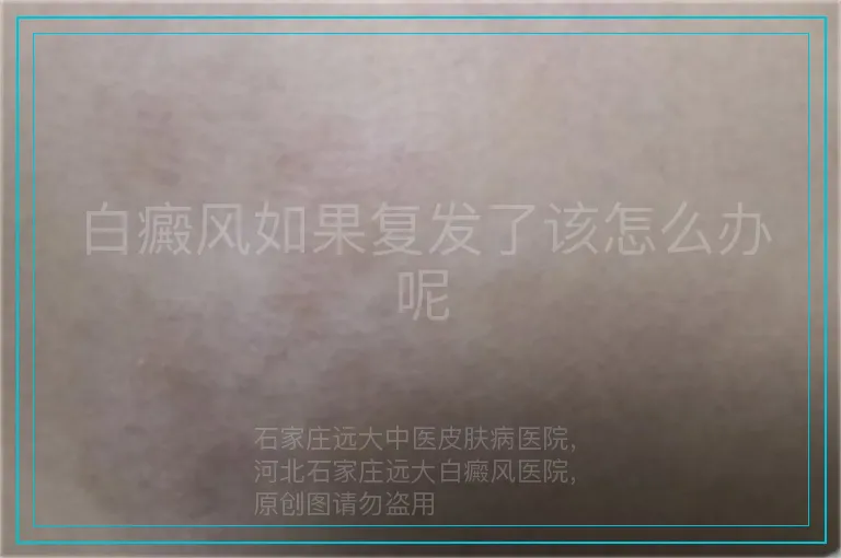 白癜风如果复发了该怎么办呢