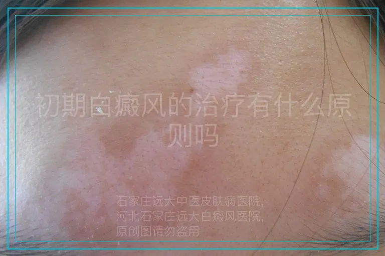 初期白癜风的治疗有什么原则吗