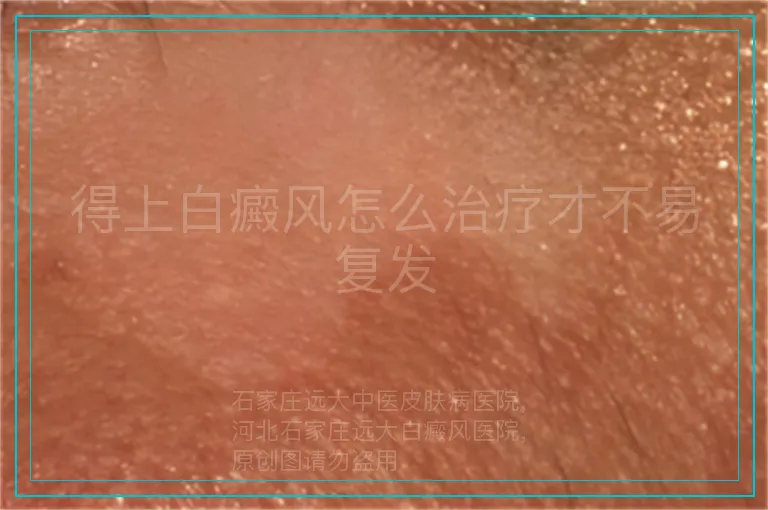 得上白癜风怎么治疗才不易复发