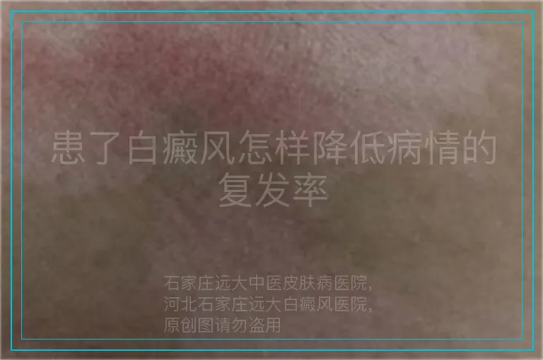 患了白癜风怎样降低病情的复发率
