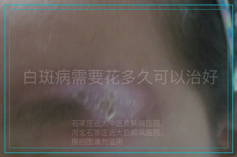 白斑病需要花多久可以治好