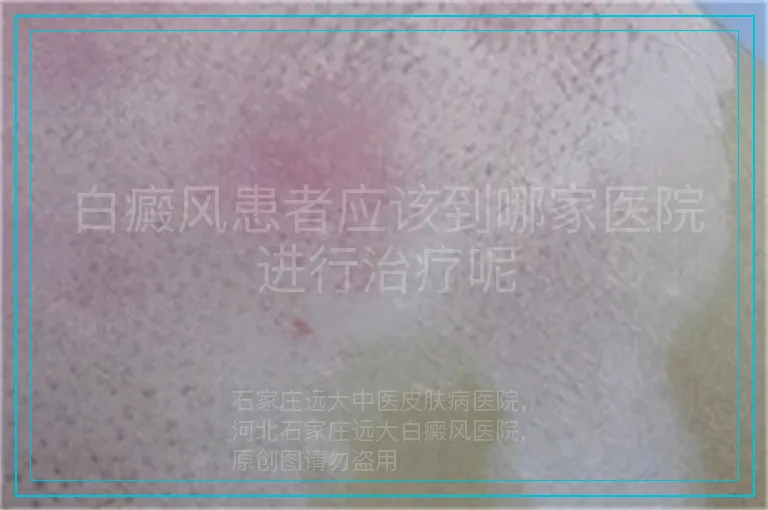 白癜风患者应该到哪家医院进行治疗呢