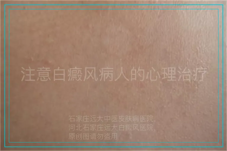 注意白癜风病人的心理治疗