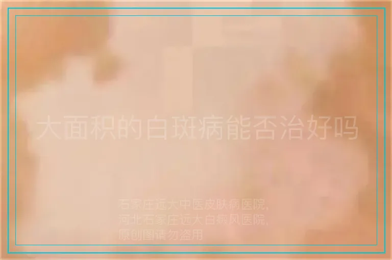大面积的白斑病能否治好吗