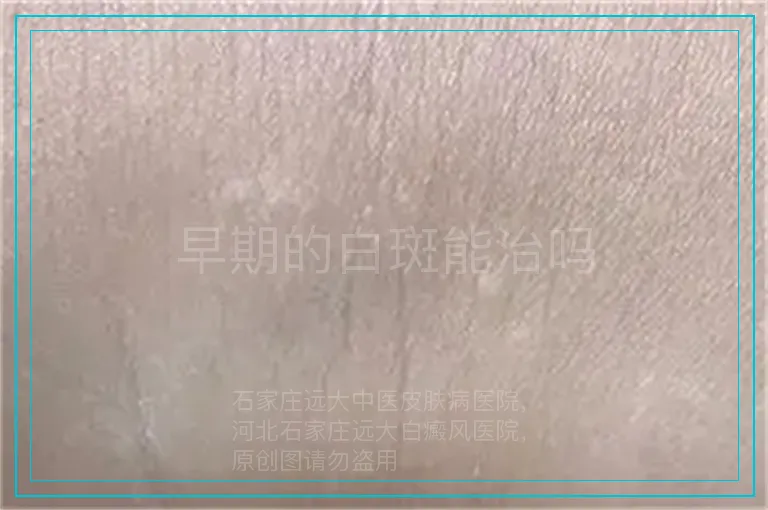 早期的白斑能治吗