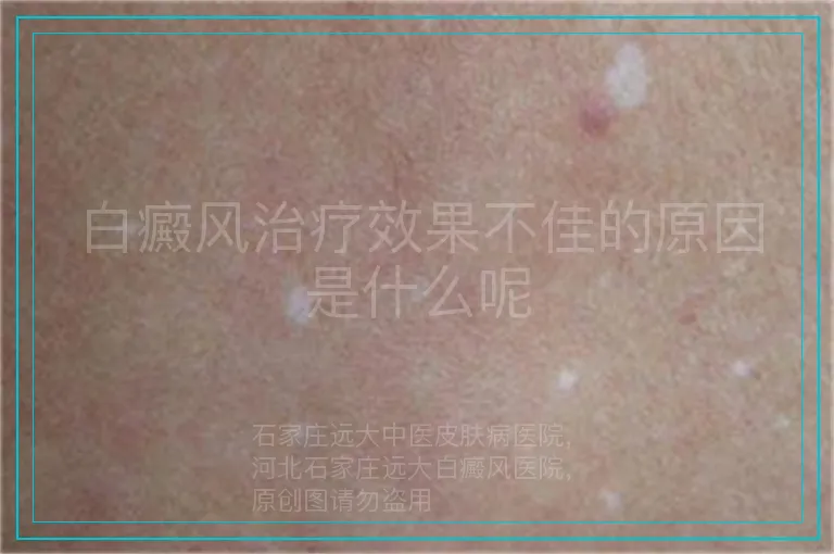 白癜风治疗效果不佳的原因是什么呢