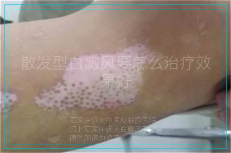 散发型白癜风要怎么治疗效果好