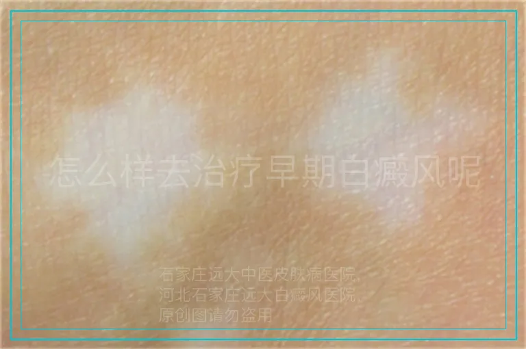 怎么样去治疗早期白癜风呢